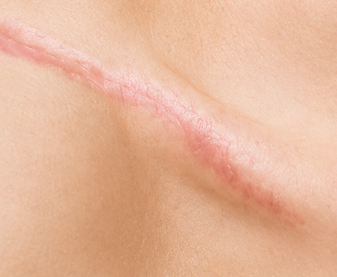 Raised Scars