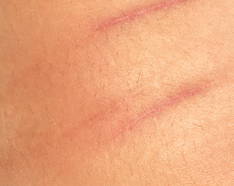 Red Scars
