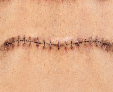 Surgical Scars